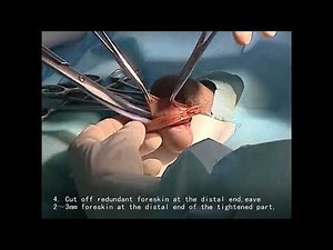 The Shang Ring Male Circumcision-Non-Flip Circumcision Surgery with Topical Anesthesia