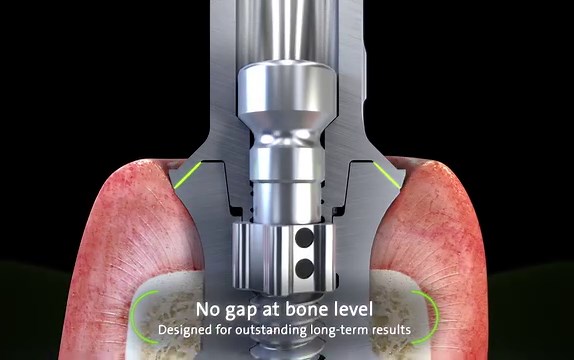 Torcfit Connection! Designed to optimize the restorative workflow. Straumann TLX now available! Contact your local rep for details about Straumann TLX! #straumann #tlx #immediexy | Straumann | Facebook