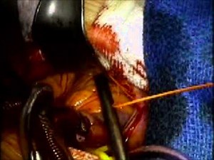 Minimally Invasive Left Atrial Myxoma Resection with "Invisible" Scar  • Video • MEDtube.net