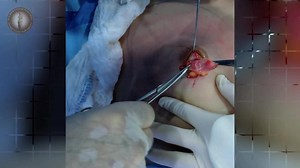 Gynecomastia Surgery - Male Chest Reduction (GRAPHIC)