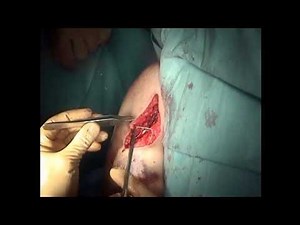 Shoulder Surgery - Humerus Fracture Repair  • Video • MEDtube.net