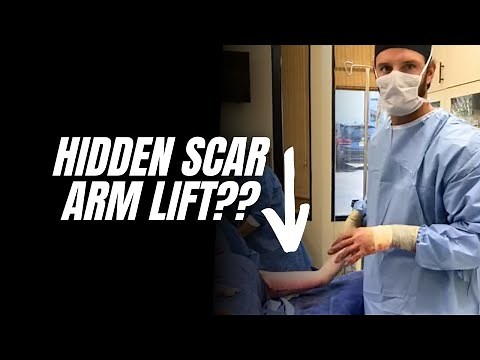 Hidden Scar Brachioplasty (arm lift)