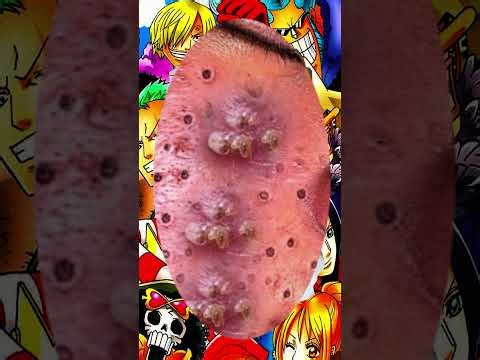 Blackheads Removal #141 | Acne Treatment and Very Satisfying Satisfying Pimple pop #blackheads