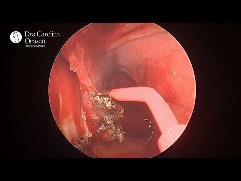 Endoscopic Medial Maxillectomy – Step-by-Step Annotated Surgery | Dr. Carolina Orozco