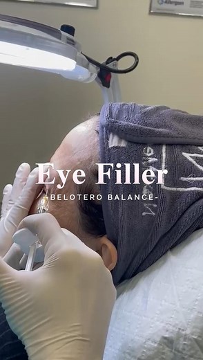  "Awaken Your Eyes with Belotero Eye Filler! ️✨ Elevate your gaze...