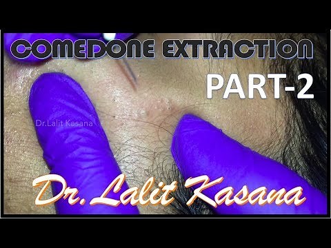 COMEDONE EXTRACTION by Dr.Lalit Kasana PART-2