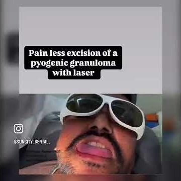 painless excision of pyogenic granuloma with laser