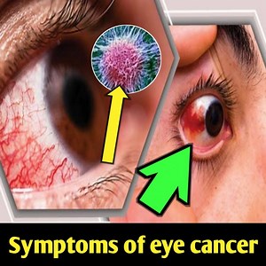 Symptoms of eye cancer | Health Tricks & Tips English