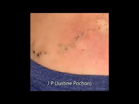 Unique !!!! Removal of an enormous chain of impressive cysts in back... Acne ?? Blackheads ??
