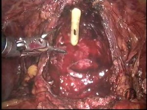 The Role of the Bedside Assistant during Robotic Radical Prostatectomy