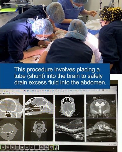 Success Story: Ventriculoperitoneal (VP) Shunt Placement