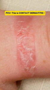 44K views · 85 reactions | This isn’t acne or an infection. Contact dermatitis happens when your skin reacts to something it touched — skincare, fragrance, metal, fabric, or even detergent. Red, itchy, bumpy patches = your skin barrier is inflamed. Remove the trigger early and get proper treatment to prevent it from worsening. | Dr Lim Ing Kien | Facebook