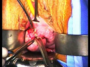 Skene's Duct Abscess