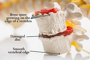 What does a bone spur on the spine feel like? - Spinal Backrack