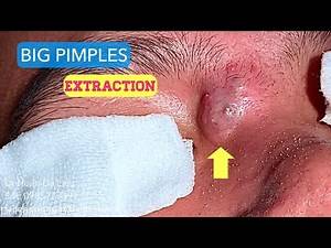 Chích nhọt to ở hốc mắt|Dermatologist,pimples,blackhead,anti acne,pustule extraction 0985773391