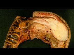 What is Intussusception? - Pathology mini tutorial