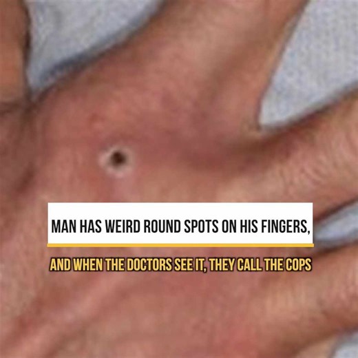 Man Has Weird Round Spots On His Fingers, And When The Doctors See It, They Call The Cops | Trending Videos In The World