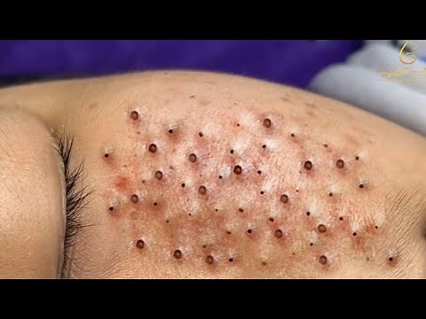 Remove Blackheads and Pimples Popping At HT Spa #47