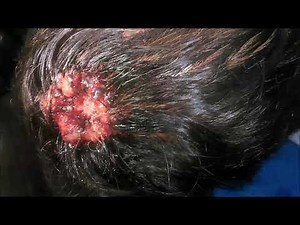 Maggots In Scalp
