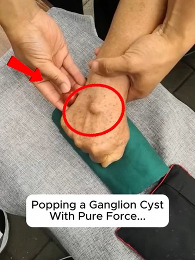 Understanding Ganglion Cysts and Their Treatments