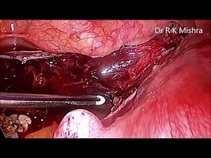 Total Laparoscopic Hysterectomy (TLH in Full HD)
