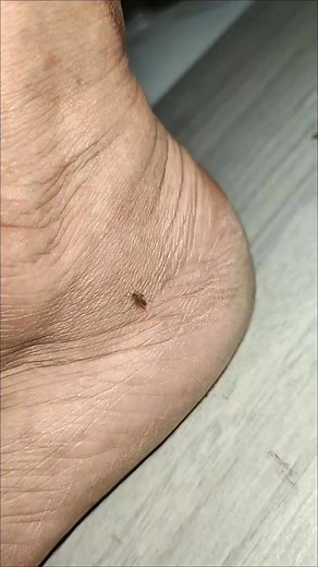 Mosquito !!Mosquito shock #MosquitoFree #mosquitos #realestate #reallife #realtor #realestateagent #videos #videorealls #fbreelsfypシ゚viral #fypシ゚viralシ #fypシ゚ #fypシ゚viralシ2024fyp #news #NewsUpdate #viralreelsシ #viralpost | Space Blind