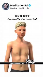 🩻 Pectus excavatum bracing is a non-surgical treatment for the sunken chest. A custom-made brace is worn to apply gentle pressure, gradually reshaping the chest over time. This treatment is often recommended for children and adolescents, as their chests are more malleable. Regular adjustments and monitoring are necessary to ensure optimal results. Please consult a medical professional for personalized advice. #sunkenchest #pectusexcavatum #pectusbracing #pectusawareness #pectusrepair #chestwall