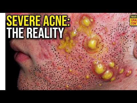 The Most Satisfying Deep Acne Extractions With Relax Music | Clinical Pimple Popping Compilation