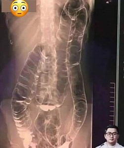 This is an X-ray image of a young woman who suffered from chronic constipation. One day, after experiencing continuous symptoms for over two weeks, she went for a medical check-up and received the X-ray results shown below in comm... Check 1st comment for details😳 | Dream Story