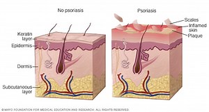 Psoriasis - Síntomas y causas - Mayo Clinic