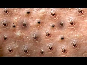 Amazing Blackheads Remover on the Face #008