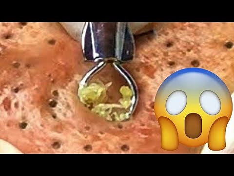 World Biggest Blackheads, Blackhead Removal.