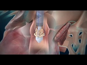 Perceval: Sutureless Aortic Valve Replacement Animation (LivaNova)