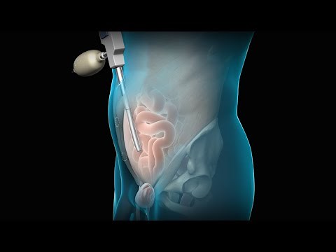 Total Extraperitoneal (TEP) Laparoscopic Inguinal Hernia Repair | Nucleus Health