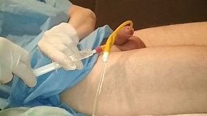 Removal catheter