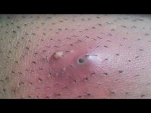 HOW TO REMOVE AN INGROWN HAIR DO THIS RIGHT NOW