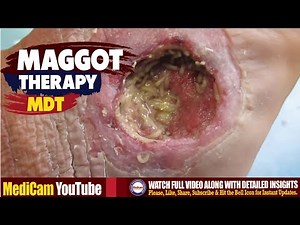 Maggot Therapy | Maggot Debridement Therapy MDT