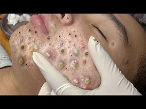 Satisfying Pimple Popping Compilation 2025 | Biggest Blackheads & Cyst Removal!"