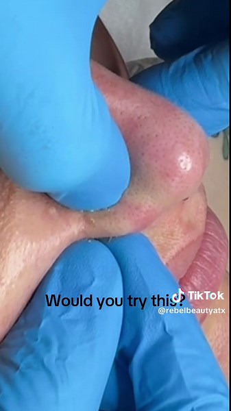 Sebaceous Filaments: Care and Extraction Tips