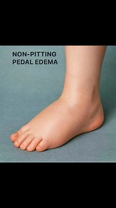 9.3K views · 50 reactions | Non‑pitting edema = firm, thick skin; no dent on pressure. Causes Infectious • Cellulitis • Filariasis (Elephantiasis) Lymphatic • Lymphedema• Post‑surgery • Cancer‑related • Infection‑related • Congenital Thyroid • Hypothyroidism / Myxedema Allergic • Angioedema• Drug‑induced • Food‑related • Insect‑related | MRCP UK | Facebook