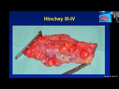 Managing and treating diverticulitis