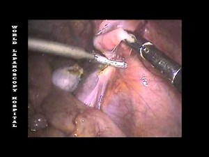 Laparoscopic Orchiectomy by Dr R K Mishra