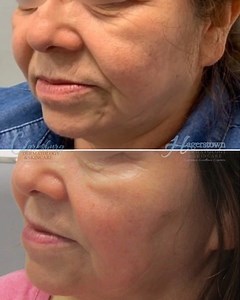 11 reactions · 4 comments | Before and after hyaluronic acid filler...