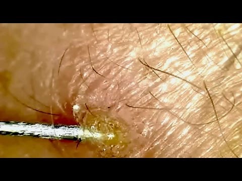 Magnified Pimple Scab Picking
