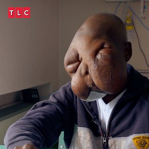 His face is engulfed by a tumour, but surgery could save his life 🤯😢 #BodyBizarre | TLC UK
