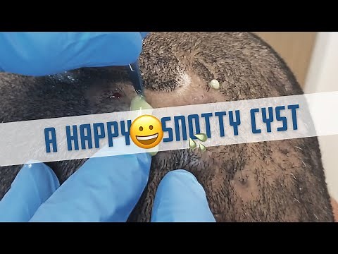 A Happy Snotty Cyst (Dissecting Cellulitis of the Scalp)