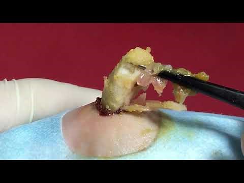 BEST Pimple Popping // Big Cystic Acne Blackheads // Whiteheads Removal / Squeezing Pimples / H#052