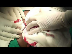 Bascom Flap Repair by Dr Pradeep Sharma AAS PROCTOCON 2022