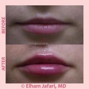  Lip augmentation and enhancement  _____________________ ...