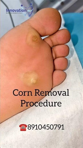 Foot Corn Removal Surgery|By Dr.Soumyobrata Bagchi#callusremoval #cornremoval#footcornremoval